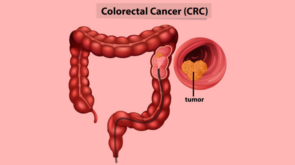 Colon Cancer